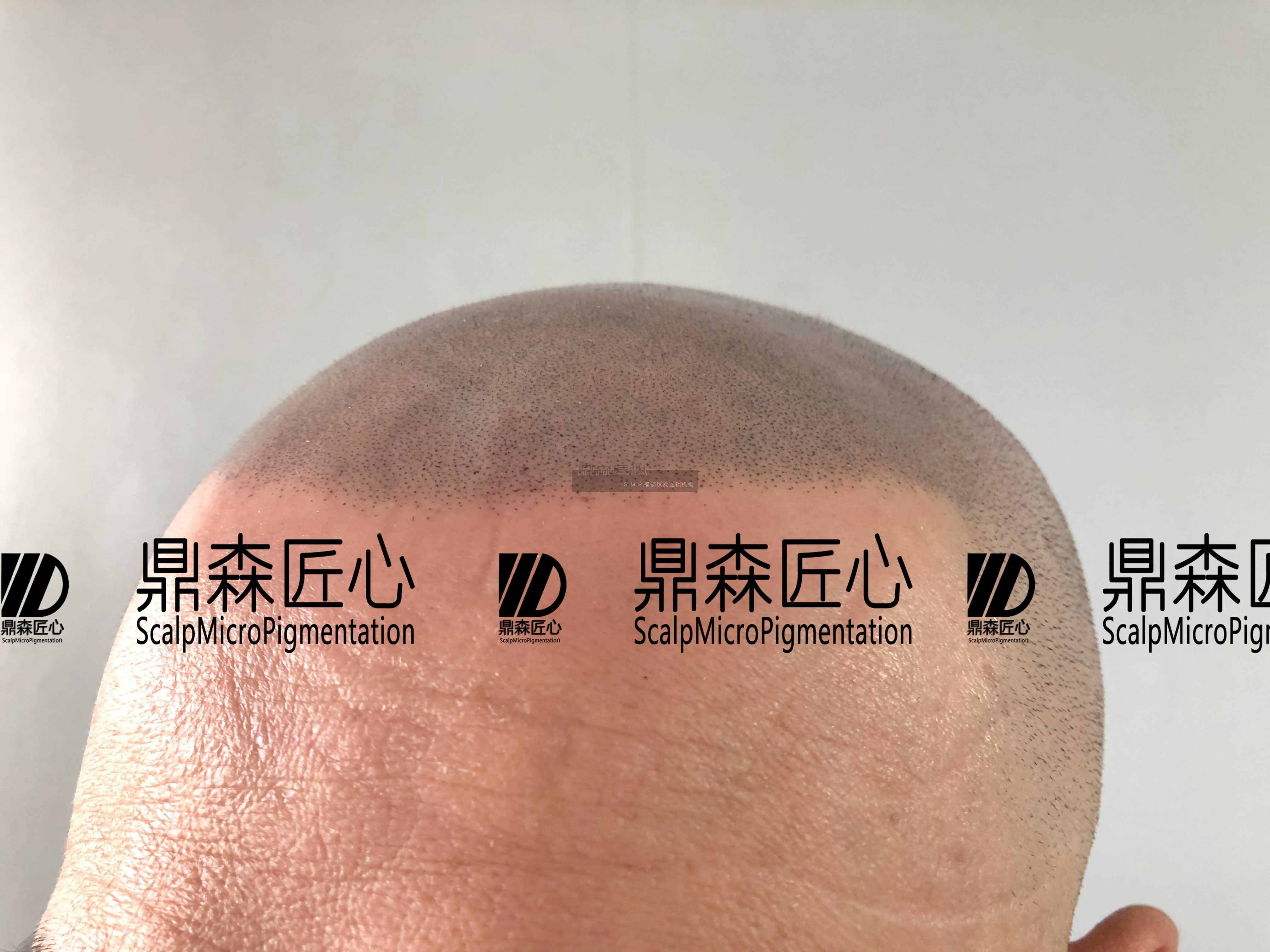 贵州纹发顾客疼痛感