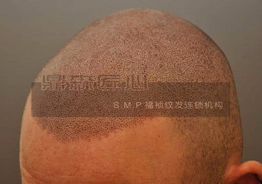 幸运邂逅纹发，生发失败经验分享