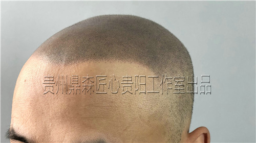 三种适合贵州纹发机构SMP技术的不同脱发条件