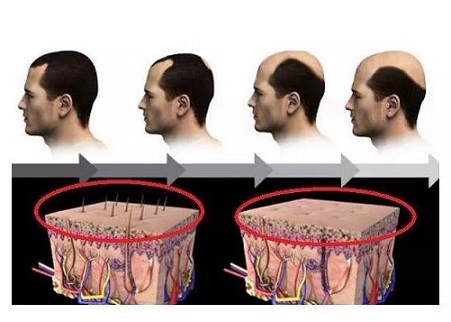 改善斑秃最快捷的办法是什么？咨询下纹发