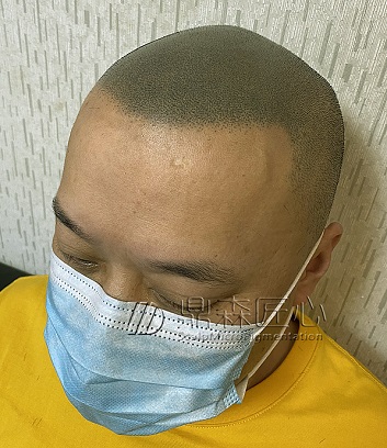 脱发的救星、终极技术-贵阳纹发