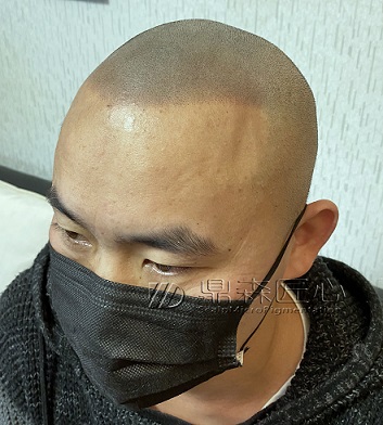 SMP纹发为脱发者定制的方案与价格的关系
