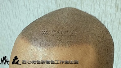 治脱无望依然不放弃，贵阳纹发让你头发重生