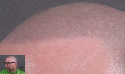 贵州纹发后还能进行植发和生发治疗吗？