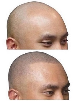 通过经验丰富的贵阳纹发师的正确操作，就难以从近距离看出有人进行了SMP