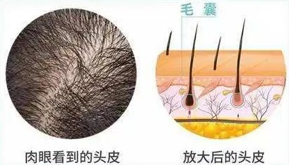 纹发会流血吗？会对我的天然毛囊产生负面影响吗？