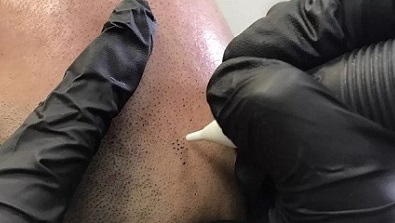 简单讲解一下关于纹发入针的深度
