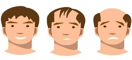 脱发到医院应该挂号哪个科室? 脱发到医院应该挂号哪个科室?
