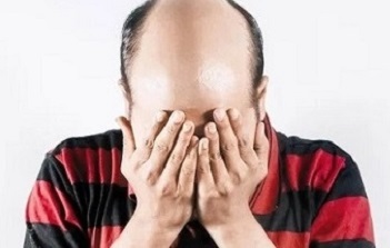 并不是发际线上移都代表着脱发的到来