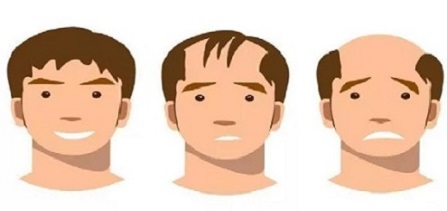 脱发趋势的核心证据