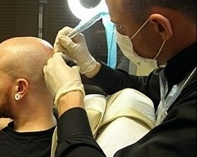 为何贵州纹发常被视为脱发患者“最后选择”？