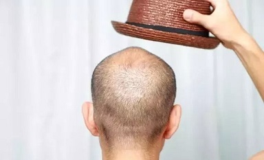 男性雄性激素脱发的遗传可以影响多少代? 男性雄性激素脱发的遗传可以影响多少代?