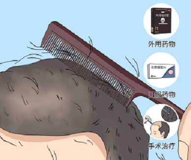 脱发圈的有哪些怪相？