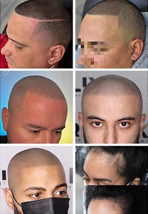 专业的贵阳纹发的核心就是靠仿真毛囊点绘 专业的贵阳纹发的核心就是靠仿真毛囊点绘