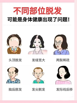 脱发能自愈的可能性及判定、养护指南