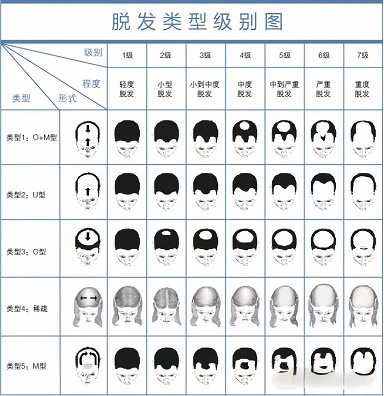 人体头发数量与健康存在双向关联 人体头发数量与健康存在双向关联
