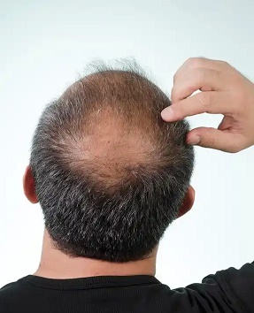 脱发最难克服的难题是什么？