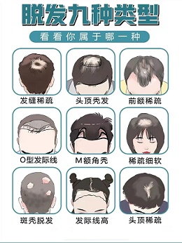 男生脱发一般从哪个位置开始？